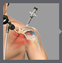 Benefits of the Arthroscopy